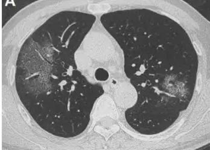 最新一学校感染新型冠状病毒:学校出现一例新冠肺炎 最新一学校感染新型冠状病毒:学校出现一例新冠肺炎