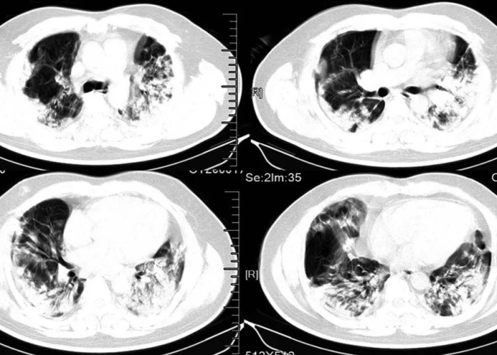 【重庆疫情清零/重庆本土新冠肺炎确诊病例“清零”】