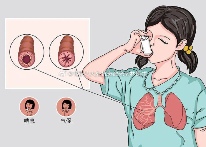 间接性肺炎,隐匿的健康威胁,这些症状需警惕 间接性肺炎,隐匿的健康威胁,这些症状需警惕