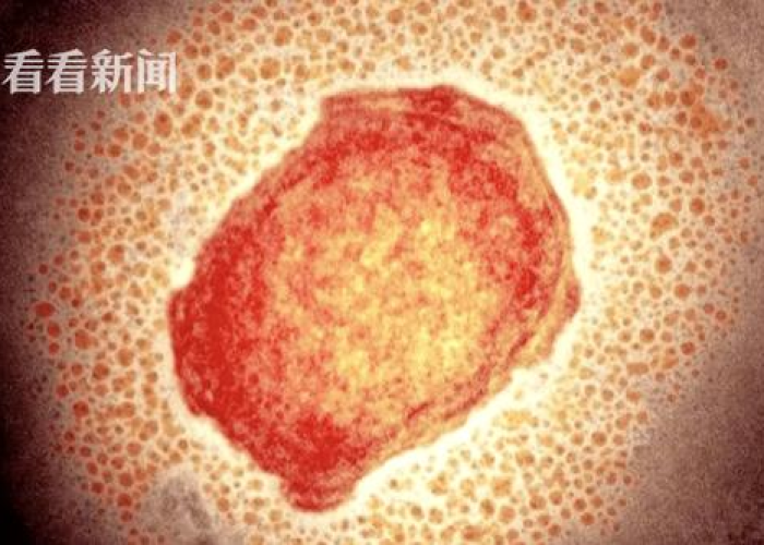 猴痘百科题目/猴痘症状 猴痘百科题目/猴痘症状