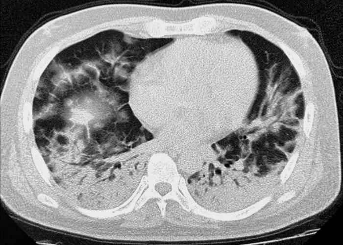 广州入境新冠肺炎情况（广州最新入境）