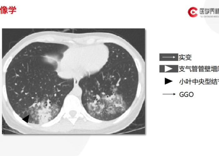 原创文章,间质性肺炎早期症状的隐匿信号与识别指南 原创文章,间质性肺炎早期症状的隐匿信号与识别指南