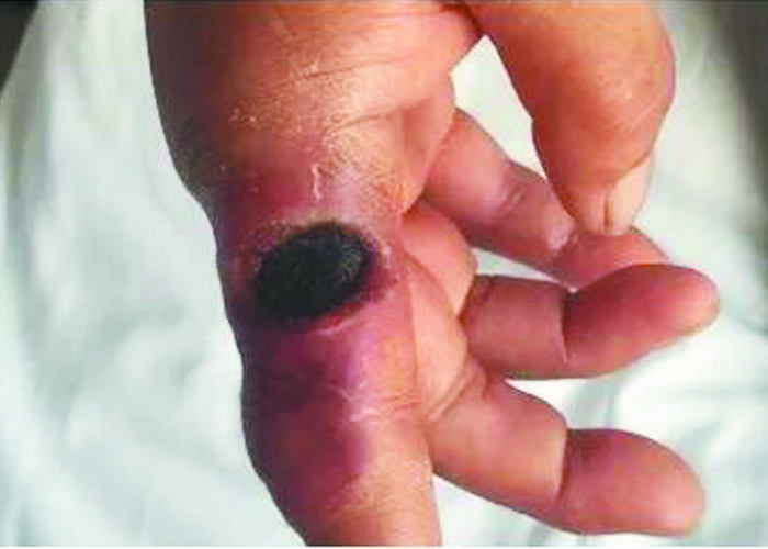 碳疽的意思/碳疽什么意思 碳疽的意思/碳疽什么意思