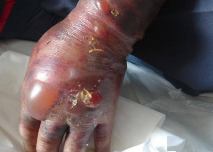 碳疽的意思/碳疽什么意思 碳疽的意思/碳疽什么意思