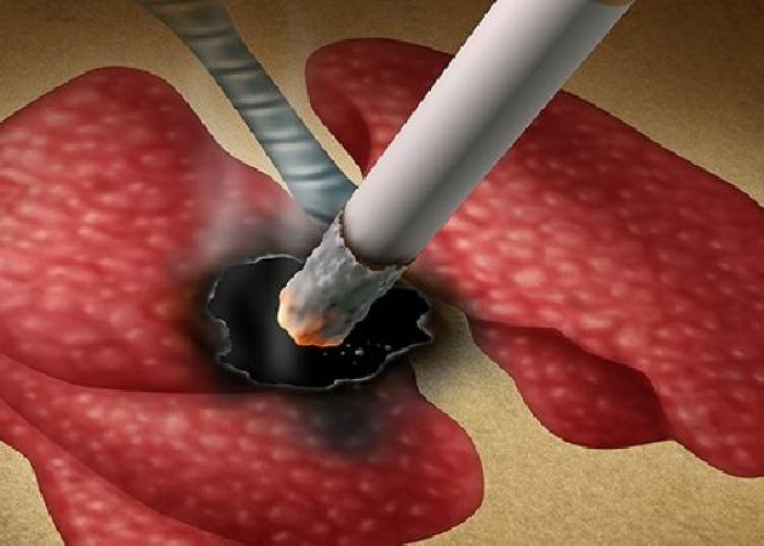 【慢性肺炎能治好吗,间质性肺炎怎么治疗比较好】 【慢性肺炎能治好吗,间质性肺炎怎么治疗比较好】