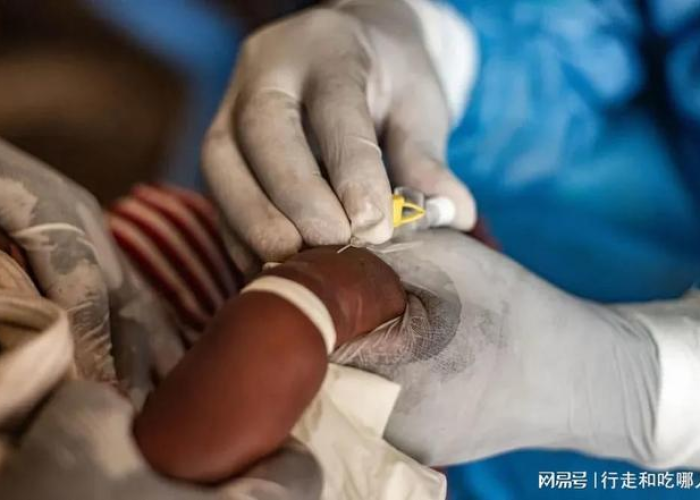 猴痘症状可以治愈吗