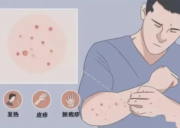 猴痘症状可以治愈吗